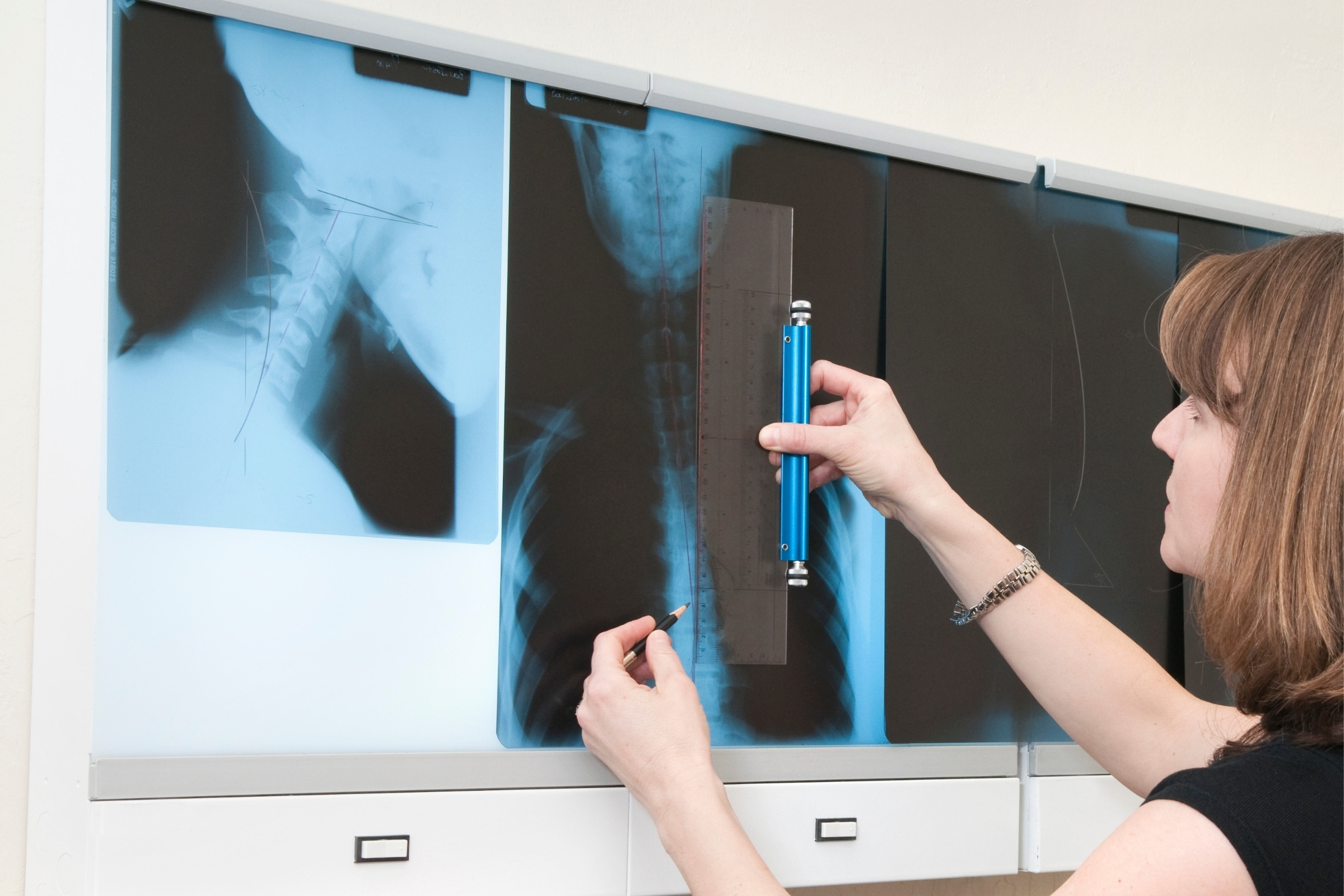 Full spine films on a viewer, measured with a ruler
